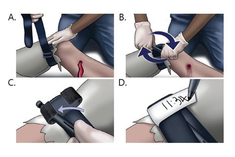 first aid tourniquet,tourniquet buckle strap,stop the bleed tourniquet,emergency tourniquet,nylon tourniquet