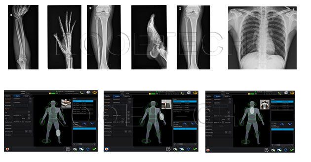 chest x ray machine, rotated chest x ray, digital radiography x ray machine